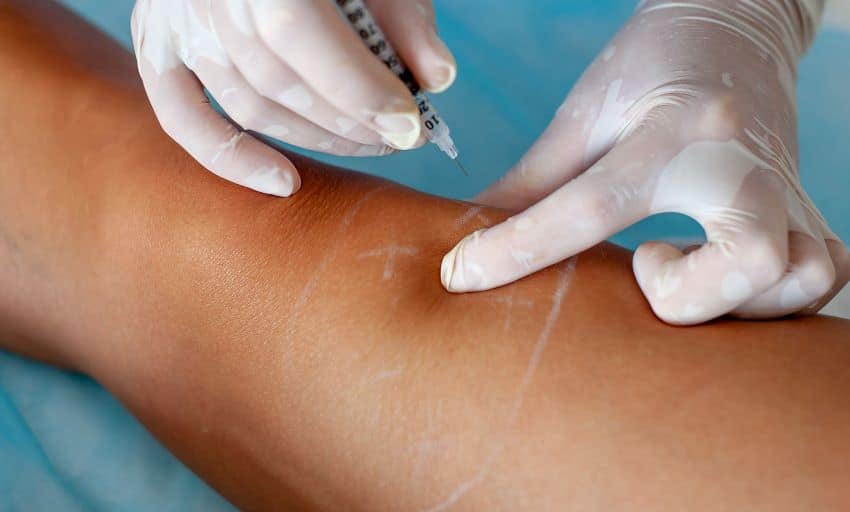 Escleroterapia: todo lo que debes saber