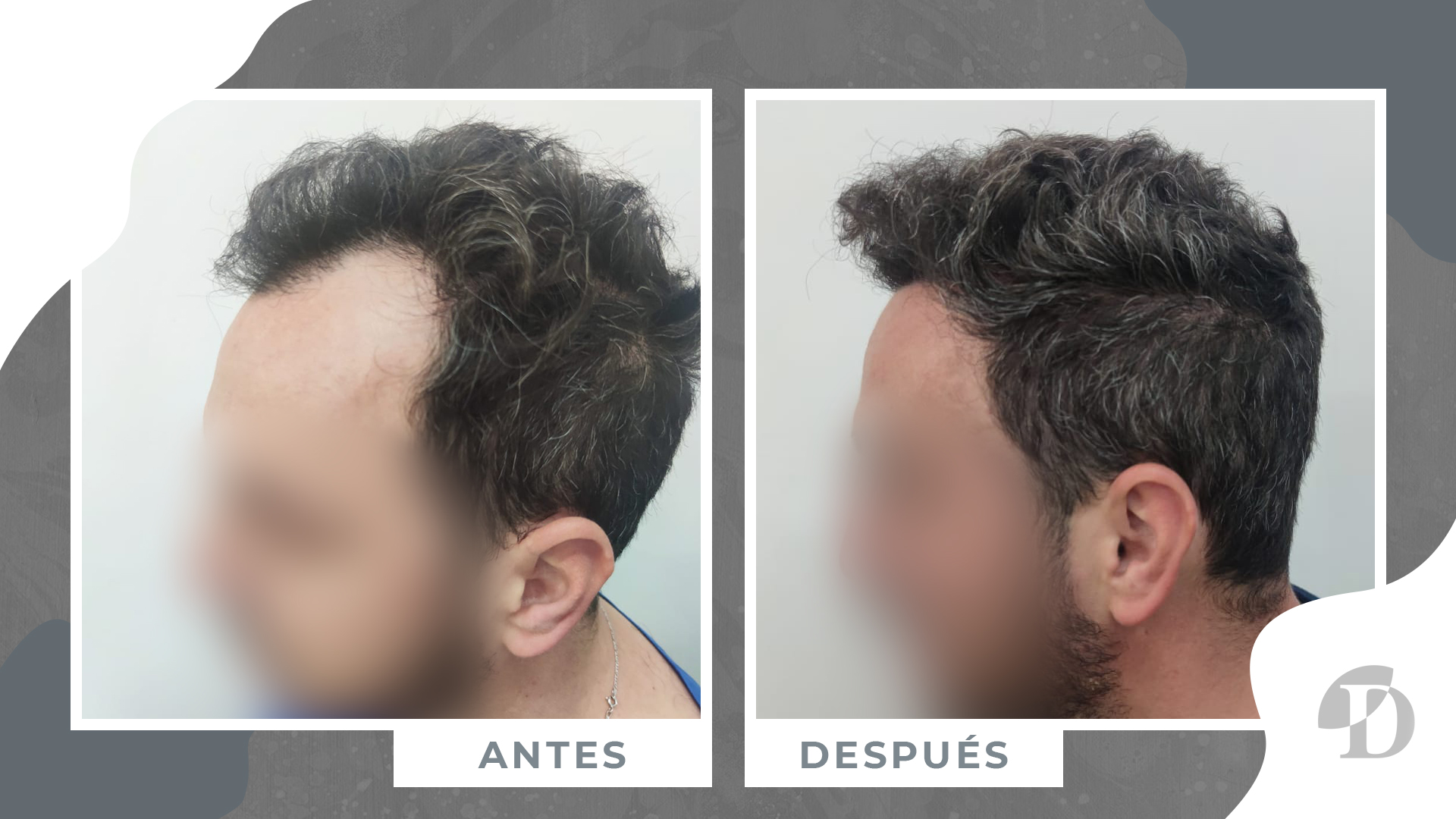 paciente 14 meses despues injerto capilar clinica devesa valencia-1