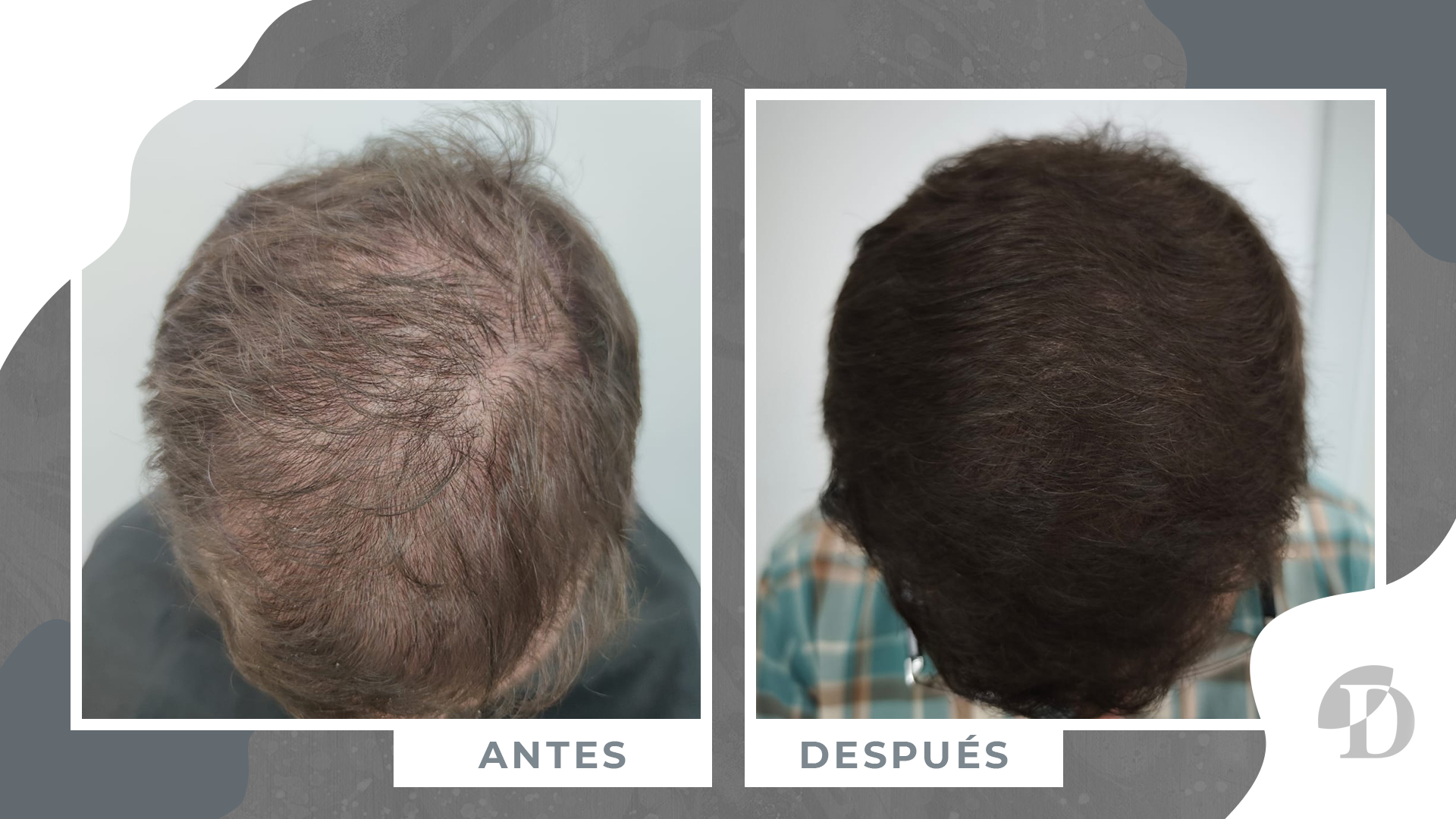paciente antes y despues 11 meses clinica devesa valencia