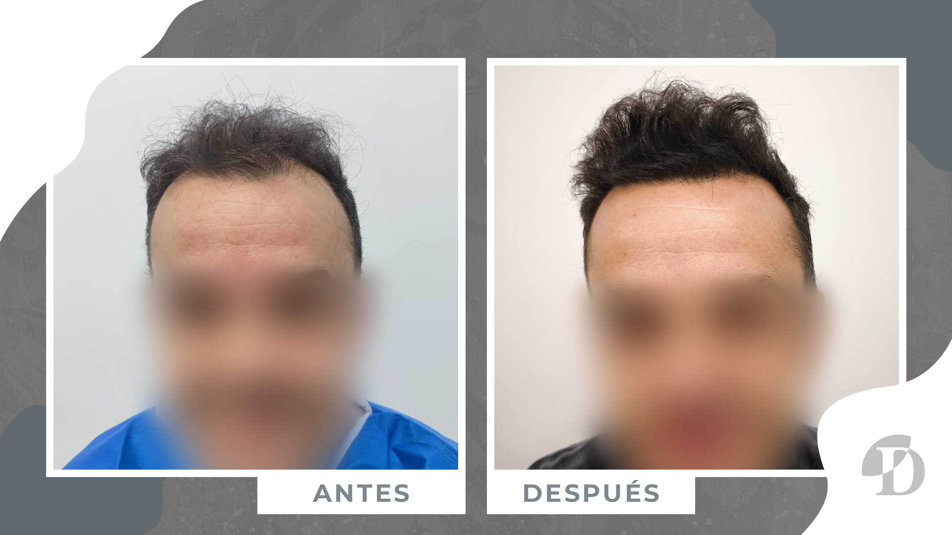 paciente antes y despues 14 meses clinica devesa valencia