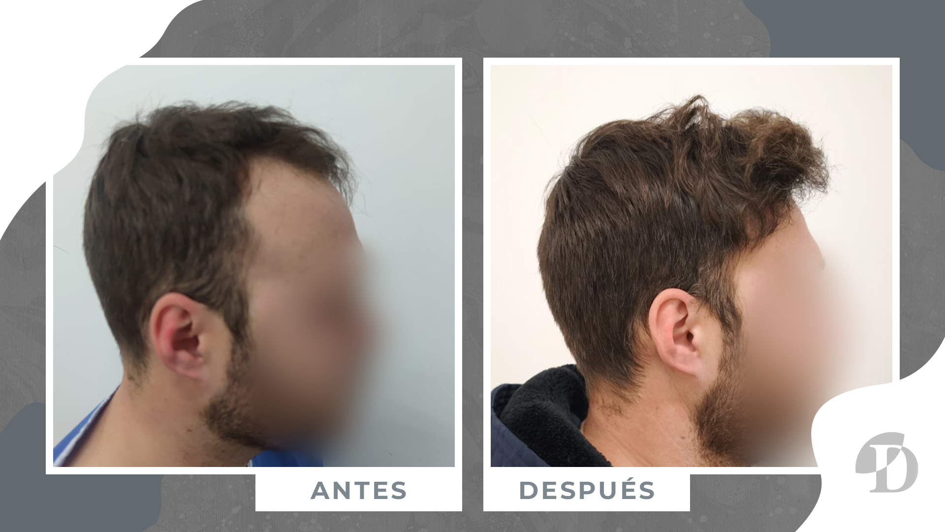 paciente antes y despues 9 meses clinica devesa valencia